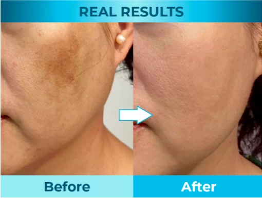 DUALCLEAR PAD result