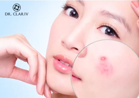Acne Prone Skin Care - DR.CLARIV