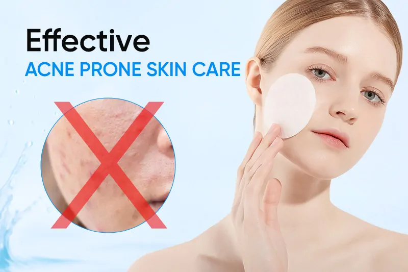 effective-acne-prone-skin-care-how-to-minimize-breakouts-with-acne-pads
